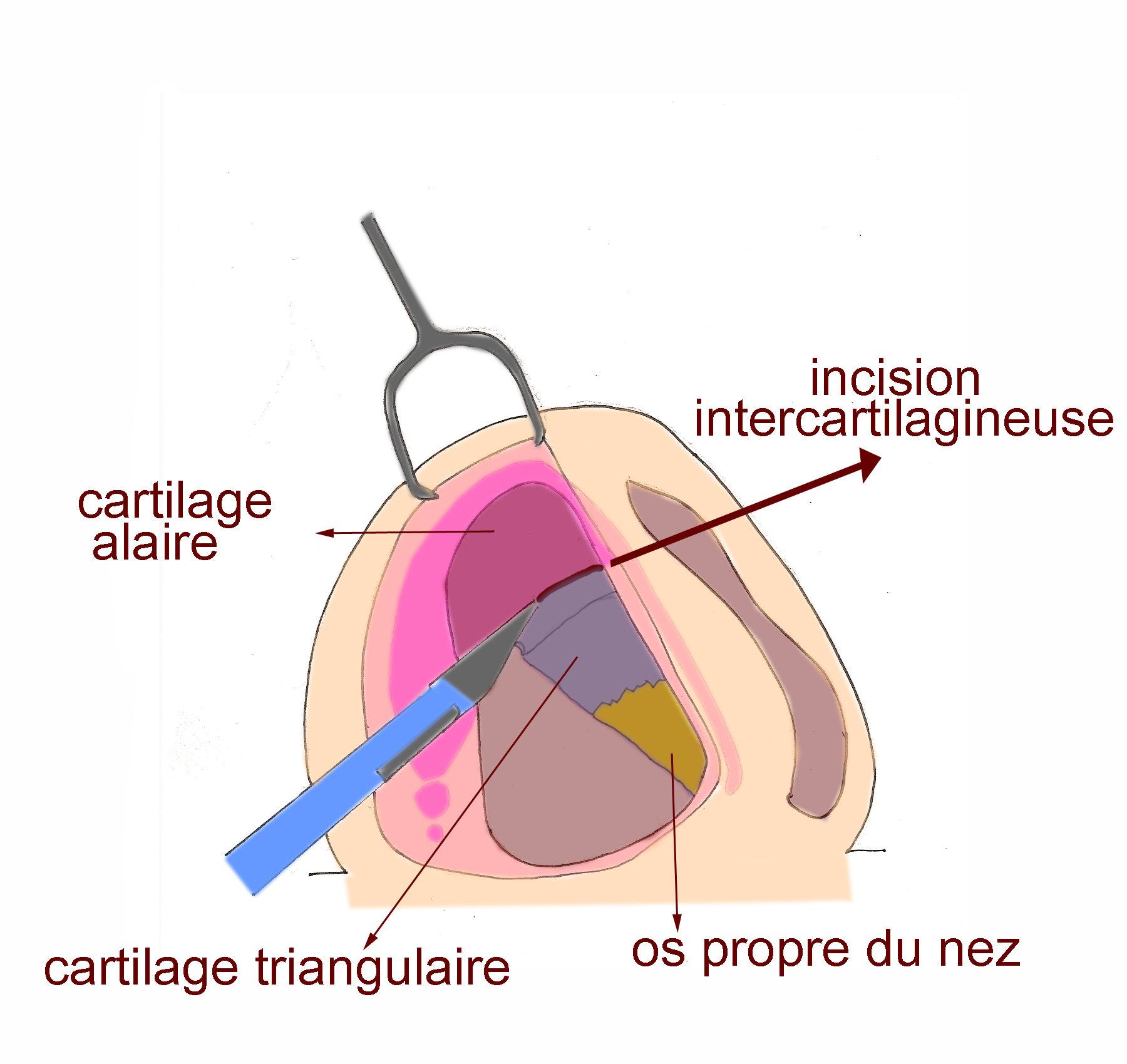 voie-dissimulee-chirurgie-esthetique-rhinoplastie