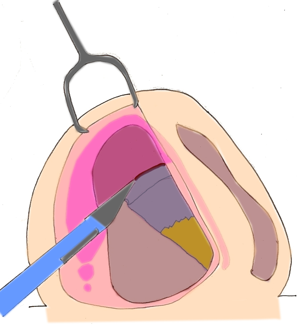 voie-dissimulee-rhinoplastie